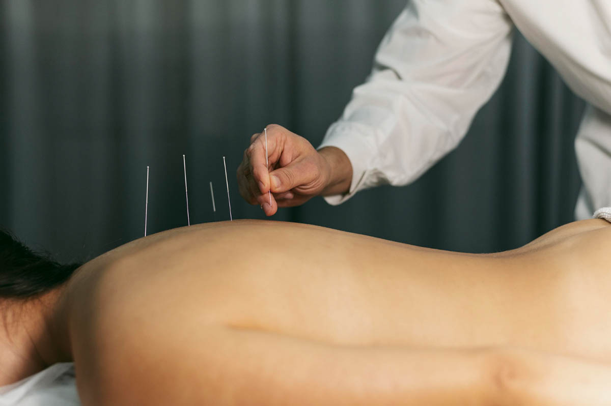 Experience Relief with Dry Needling at Wildhawk Physical Therapy