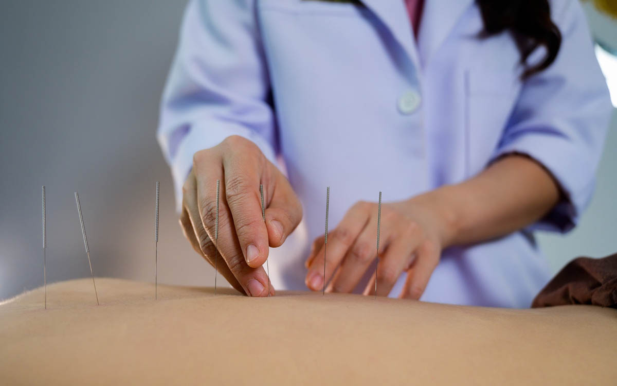 Benefits of Dry Needling for Back Pain