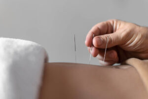 Dry Needling Explained: How It Works, Benefits & Key Facts