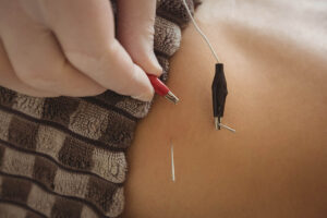 Dry Needling vs Acupuncture: Differences & Benefits