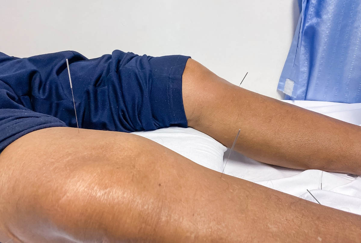 Dry Needling Techniques for Knee Pain