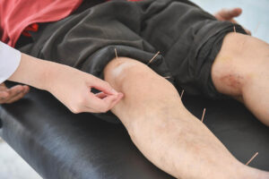 Dry Needling for Knee Pain: Effective Relief Explained