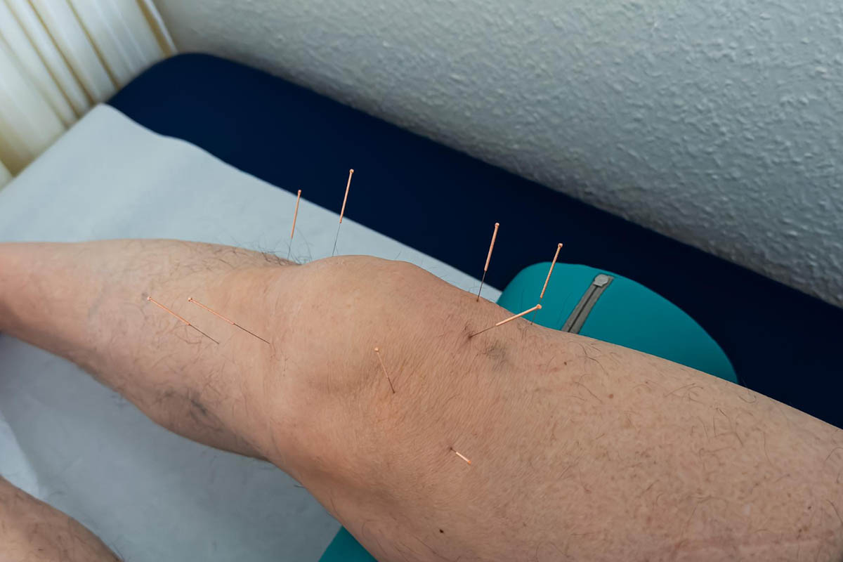 Integrating Dry Needling into a Comprehensive Knee Pain Management Plan