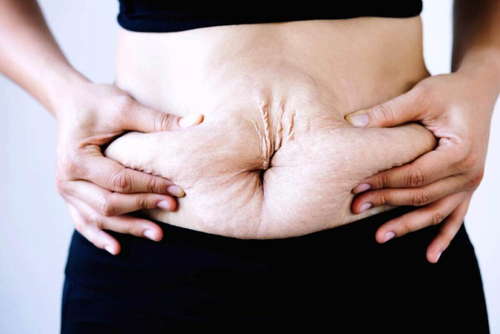 Guide to Physical Therapy for Diastasis Recti